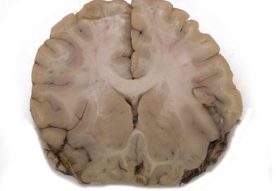 JNeurosci: ясный ум долгожителям обеспечивает белое вещество головного мозга