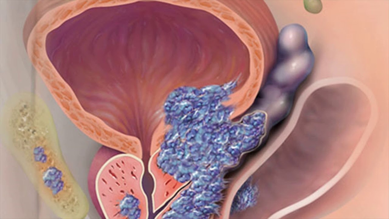 Рак предстательной железы симптомы у мужчин первые признаки фото
